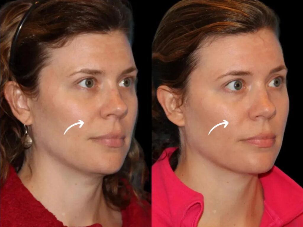 Sculptra Fillers in Dubai for Malar Fat Pad Loss