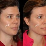 Sculptra Fillers in Dubai for Malar Fat Pad Loss