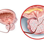 Common BPH Risk Factors and How They Affect Men