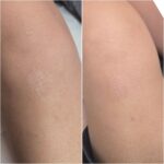 Laser Scar Removal Explained: Techniques & Benefits