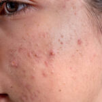 Laser Acne Treatment: Reducing Scars and Blemishes