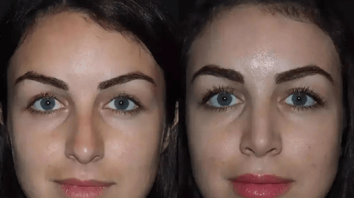 Rhinoplasty in Dubai: Modern Nose Reshaping with Trusted Results