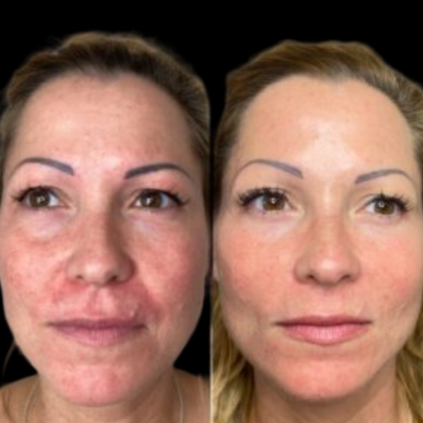 Profhilo Treatment in Dubai for Natural Skin Renewal