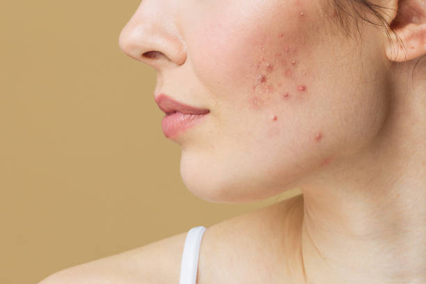 Understanding Pimples Treatment for Acne Control