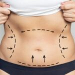 Best Doctors in Dubai Delivering Natural-Looking Liposuction Results