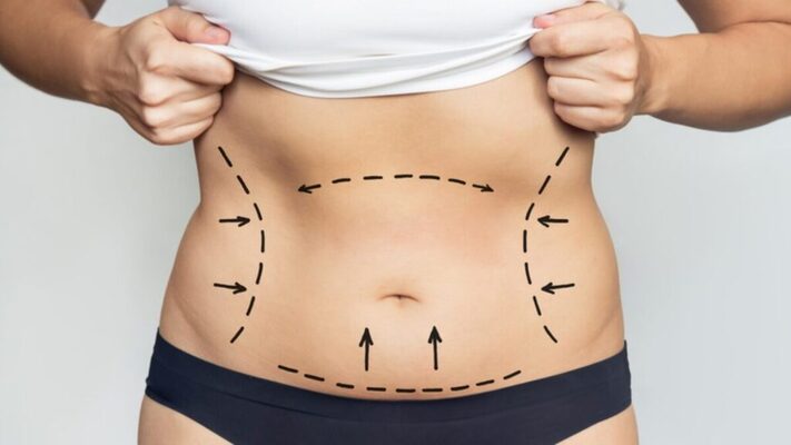 Best Doctors in Dubai Delivering Natural-Looking Liposuction Results