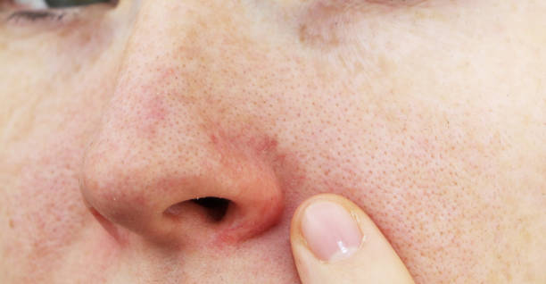 Red Skin Around Nose: Key Causes and Home Treatment Tips