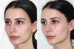 Ultrasonic Rhinoplasty in Dubai: Advanced Nose Surgery for Precise and Natural Results