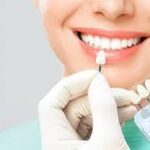 How to Maintain Your Veneers in Dubai for Long-Lasting Results