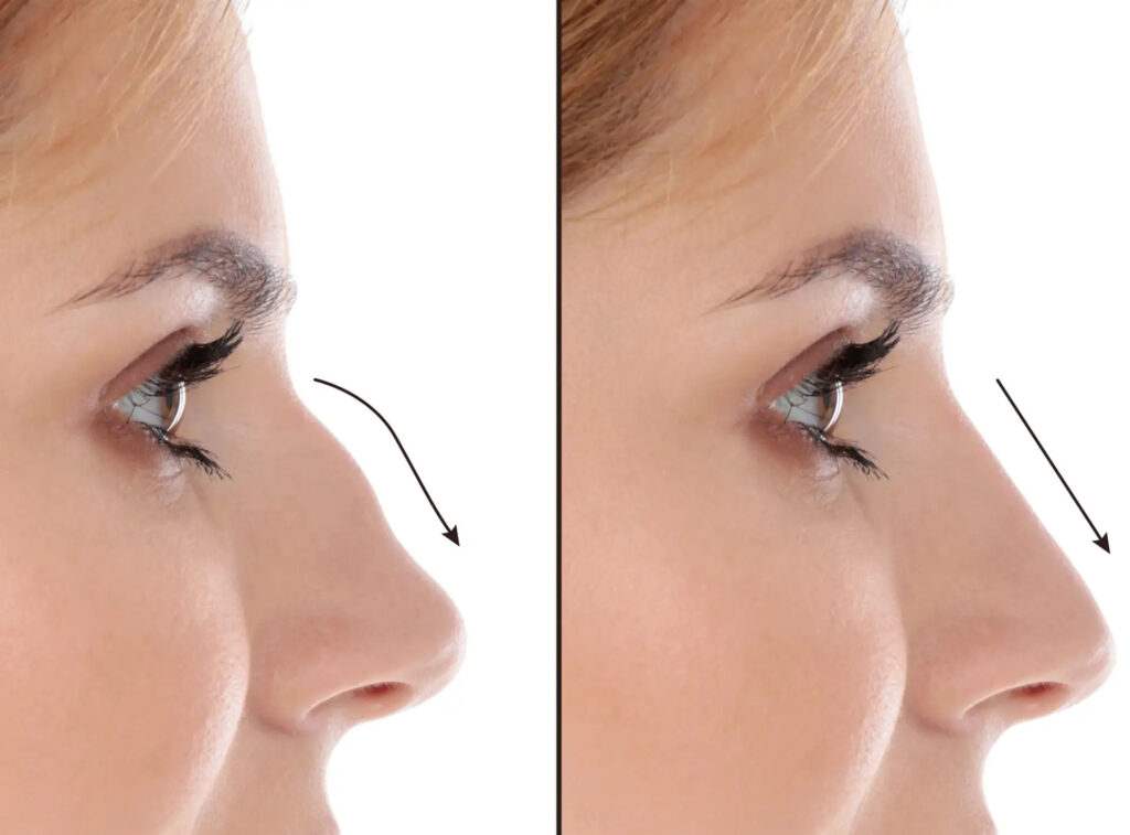 Best Septoplasty Surgeon in Dubai: Functional Results Over Time