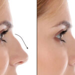 Best Septoplasty Surgeon in Dubai: Functional Results Over Time