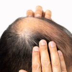 Stem Cell Hair Loss Treatment as a Breakthrough in Hair Care
