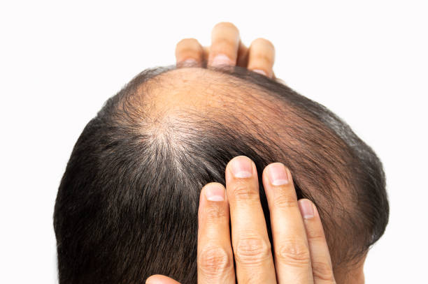 Stem Cell Hair Loss Treatment as a Breakthrough in Hair Care
