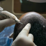 Daily Life After Hair Transplant: Work, Exercise, and Travel