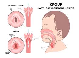 Is Croup Disease Contagious? What You Need to Know