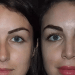 Rhinoplasty Expertise Offered by the Best Doctors in Dubai
