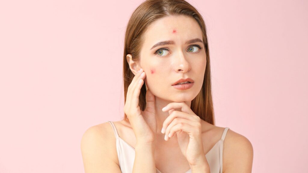 Hormonal Acne Treatment in Dubai Explained