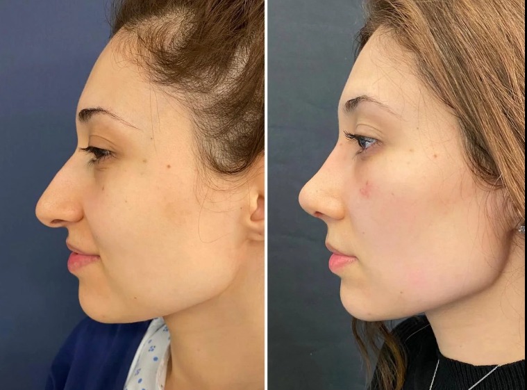 Safe and Certified Fat Grafting in Dubai