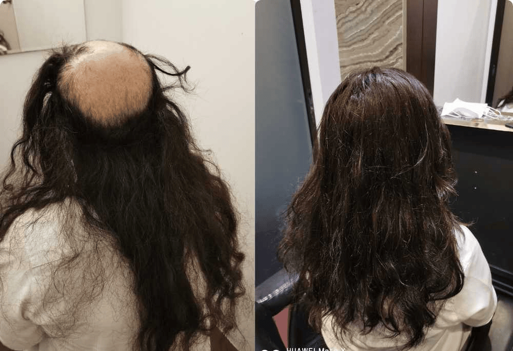 Hair Replacement Singapore