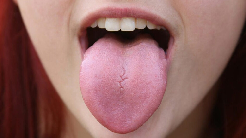 Top Home Remedies to Heal Burnt Tongue Quickly