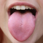 Top Home Remedies to Heal Burnt Tongue Quickly