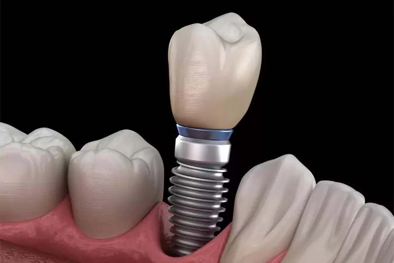 When a Dentist Recommends a Root Canal, What It Means
