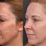 Depigmentation in Altrincham: Who Is a Good Candidate