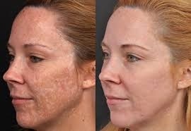 Depigmentation in Altrincham: Who Is a Good Candidate