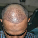 1 Dirham Hair Transplant in Dubai: Reality vs Expectations