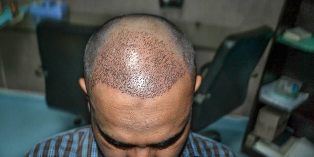 1 Dirham Hair Transplant in Dubai: Reality vs Expectations