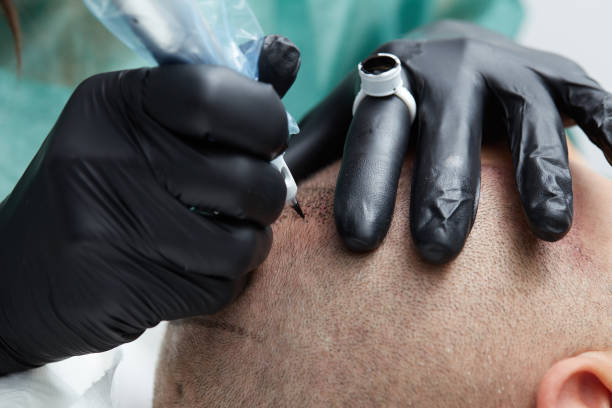 Scalp Micropigmentation in Dubai: A Complete Guide to Results