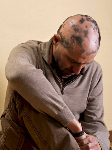 Alopecia Areata Treatment in Dubai: Navigating Clinical Options