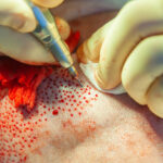 FUSS Hair Transplant in Dubai: Step-by-Step Process Overview