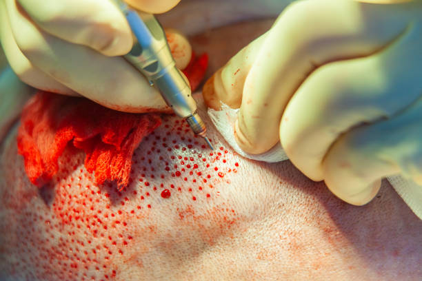 FUSS Hair Transplant in Dubai: Step-by-Step Process Overview