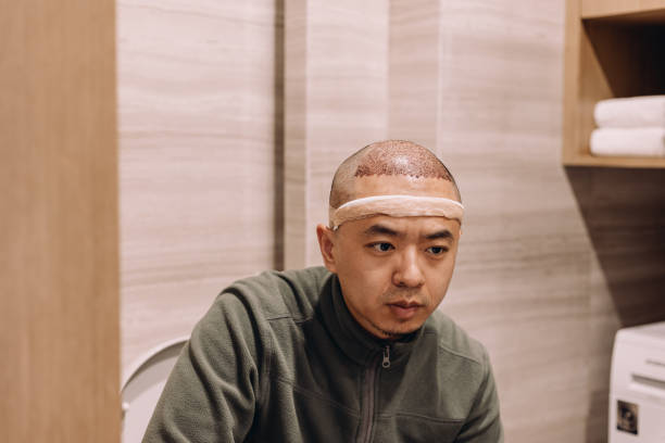 Scarless Hair Transplant in Dubai Maintenance Tips