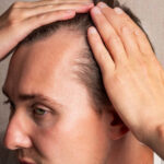 Natural Hairline Treatment in Dubai Tailored for Middle-Aged Men