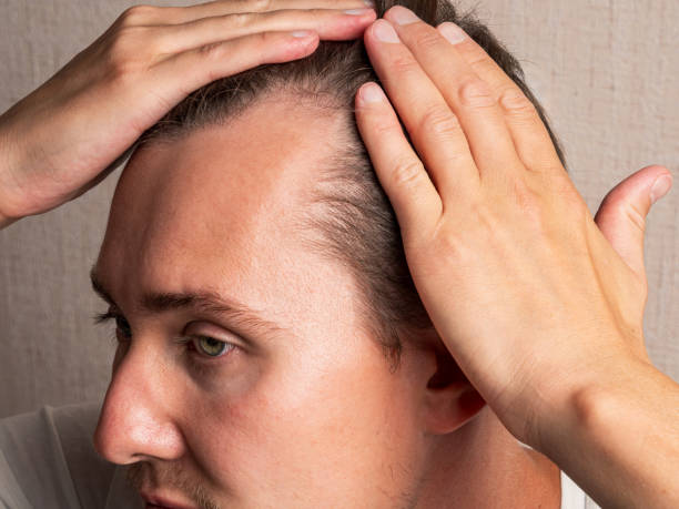 Natural Hairline Treatment in Dubai Tailored for Middle-Aged Men