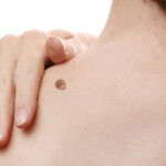 Mole Removal in Dubai: CO2 Laser for Deep Moles Fast