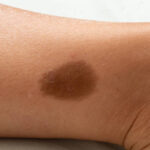 Birthmark Removal in Dubai: Permanent Results for Cafe-au-Lait
