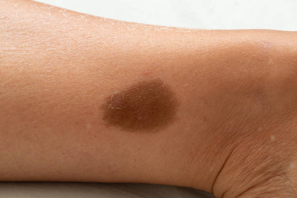 Birthmark Removal in Dubai: Permanent Results for Cafe-au-Lait