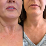 Profhilo Treatment in Dubai for Safe and Ethical Skin Therapy