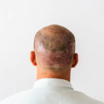 Hair Transplant in Al Ain: Minimal Scarring Advanced Techniques