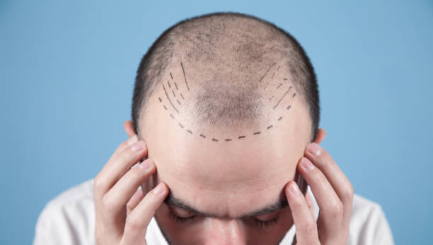 FUT Hair Transplant in Dubai: Donor Strip Harvesting Tips