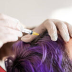 ACell PRP Treatment for Hair in Dubai: Target Androgenetic Alopecia