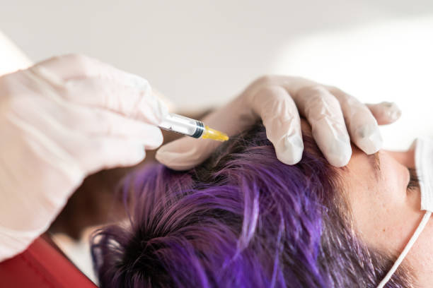 ACell PRP Treatment for Hair in Dubai: Target Androgenetic Alopecia