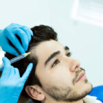 Hair Fillers Treatment in Dubai for Men with Receding Temples