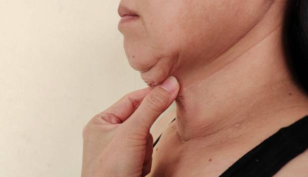 Endolift Treatment in Dubai: Lifting Sagging Neck Skin
