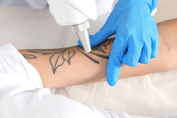 Tattoo Removal in Dubai: Results Timeline for Black Ink