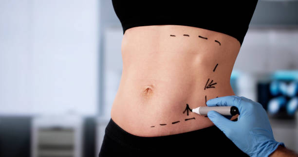 Tummy Tuck Surgery in Dubai Consultation Process Guide