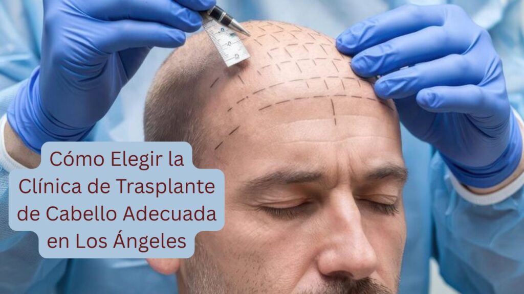 Cómo Elegir la Clínica de Trasplante de Cabello Adecuada en Los Ángeles